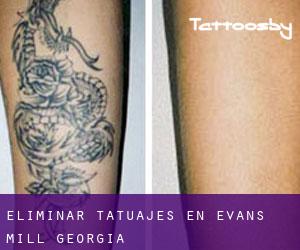 Eliminar tatuajes en Evans Mill (Georgia)