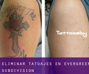 Eliminar tatuajes en Evergreen Subdivision