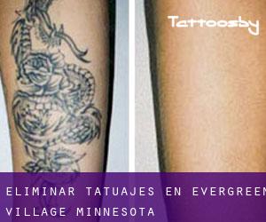Eliminar tatuajes en Evergreen Village (Minnesota)