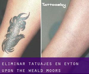 Eliminar tatuajes en Eyton upon the Weald Moors