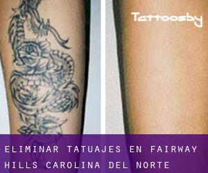 Eliminar tatuajes en Fairway Hills (Carolina del Norte)