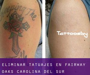Eliminar tatuajes en Fairway Oaks (Carolina del Sur)