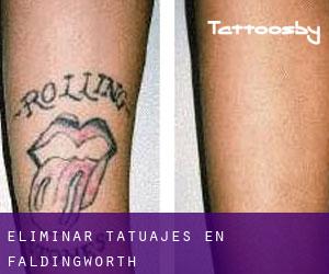 Eliminar tatuajes en Faldingworth