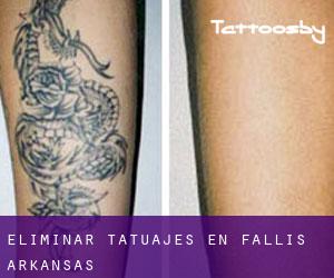 Eliminar tatuajes en Fallis (Arkansas)