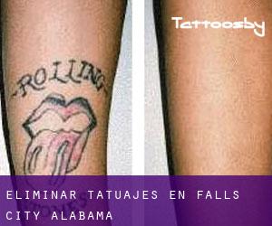 Eliminar tatuajes en Falls City (Alabama)