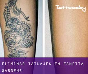 Eliminar tatuajes en Fanetta Gardens