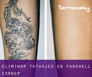 Eliminar tatuajes en Farewell Corner