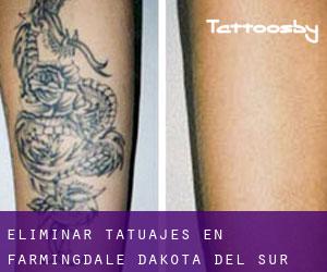 Eliminar tatuajes en Farmingdale (Dakota del Sur)