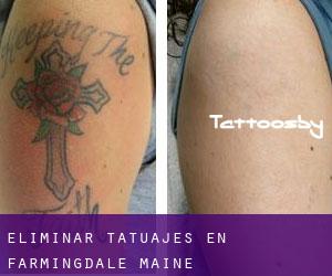 Eliminar tatuajes en Farmingdale (Maine)