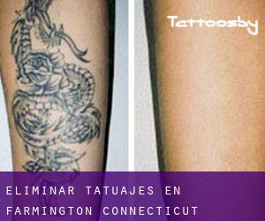 Eliminar tatuajes en Farmington (Connecticut)