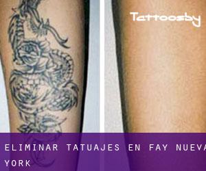 Eliminar tatuajes en Fay (Nueva York)