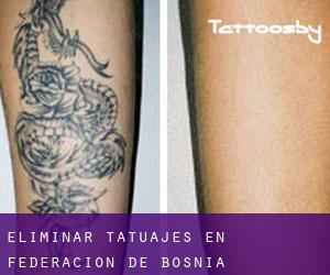 Eliminar tatuajes en Federacion de Bosnia-Herzegovina