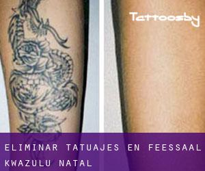 Eliminar tatuajes en Feessaal (KwaZulu-Natal)