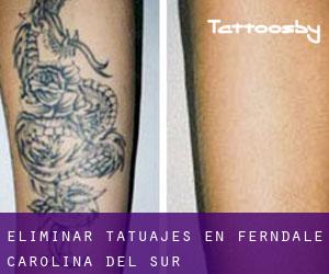 Eliminar tatuajes en Ferndale (Carolina del Sur)