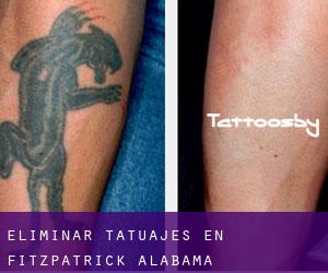 Eliminar tatuajes en Fitzpatrick (Alabama)