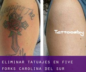Eliminar tatuajes en Five Forks (Carolina del Sur)