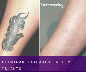 Eliminar tatuajes en Five Islands