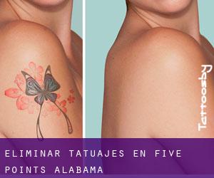 Eliminar tatuajes en Five Points (Alabama)