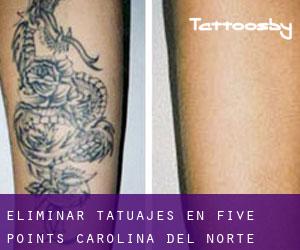 Eliminar tatuajes en Five Points (Carolina del Norte)