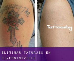 Eliminar tatuajes en Fivepointville