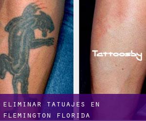 Eliminar tatuajes en Flemington (Florida)