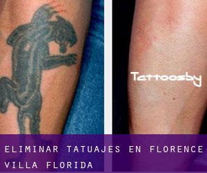 Eliminar tatuajes en Florence Villa (Florida)