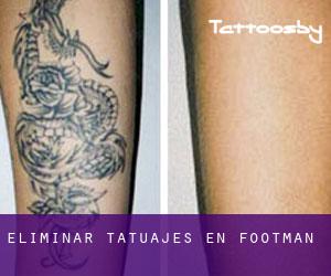Eliminar tatuajes en Footman