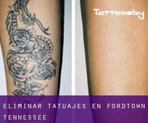 Eliminar tatuajes en Fordtown (Tennessee)