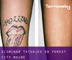 Eliminar tatuajes en Forest City (Maine)