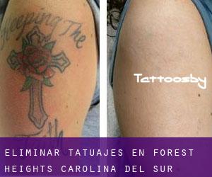 Eliminar tatuajes en Forest Heights (Carolina del Sur)