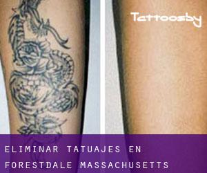Eliminar tatuajes en Forestdale (Massachusetts)