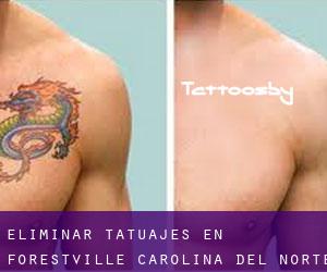 Eliminar tatuajes en Forestville (Carolina del Norte)