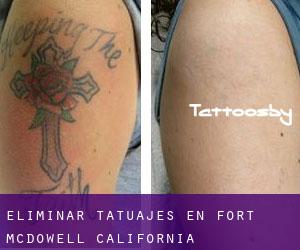 Eliminar tatuajes en Fort McDowell (California)