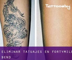 Eliminar tatuajes en Fortymile Bend