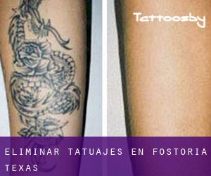 Eliminar tatuajes en Fostoria (Texas)