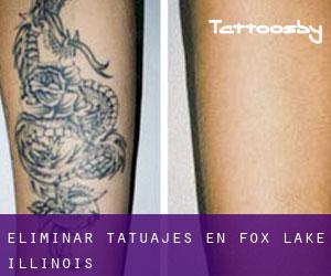 Eliminar tatuajes en Fox Lake (Illinois)