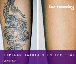 Eliminar tatuajes en Fox Town (Kansas)