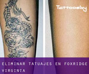 Eliminar tatuajes en Foxridge (Virginia)