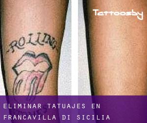 Eliminar tatuajes en Francavilla di Sicilia
