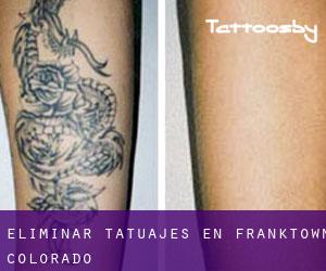 Eliminar tatuajes en Franktown (Colorado)