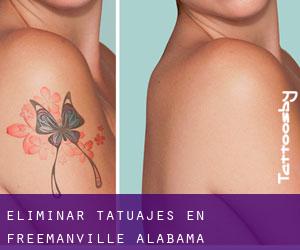Eliminar tatuajes en Freemanville (Alabama)
