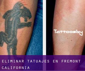 Eliminar tatuajes en Fremont (California)