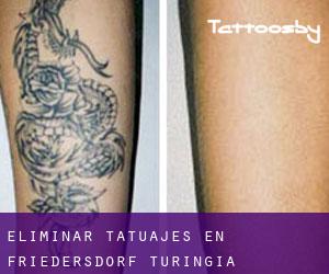 Eliminar tatuajes en Friedersdorf (Turingia)