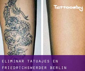Eliminar tatuajes en Friedrichswerder (Berlín)