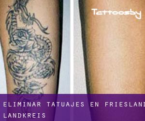 Eliminar tatuajes en Friesland Landkreis