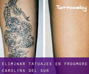 Eliminar tatuajes en Frogmore (Carolina del Sur)