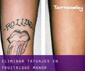 Eliminar tatuajes en Fruitridge Manor