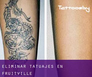 Eliminar tatuajes en Fruitville