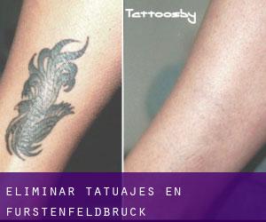 Eliminar tatuajes en Fürstenfeldbruck
