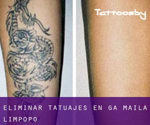 Eliminar tatuajes en Ga-Maila (Limpopo)